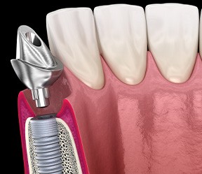 A 3D illustration of a dental implant’s abutment