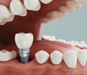 A 3D illustration of a dental implant with its final restoration