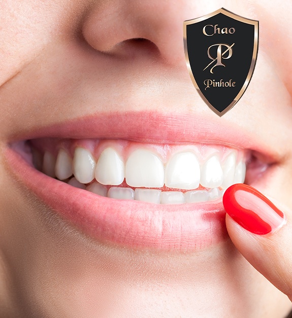 Healthy smile after Chao Pinhole surgical technique treatment