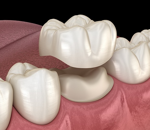 Animated smile during dental crown placement