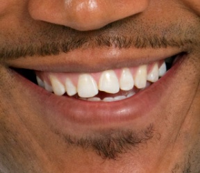 Closeup of smile with chipped front tooth