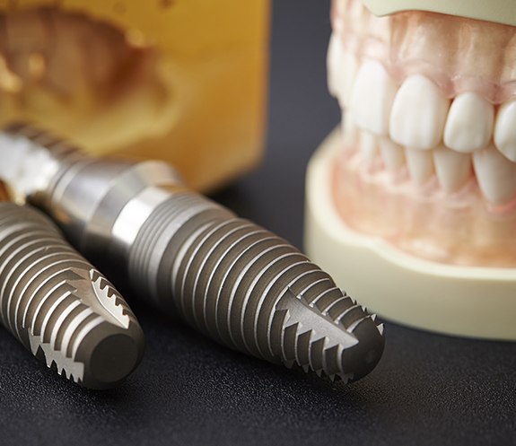 Model smile and dental implant posts