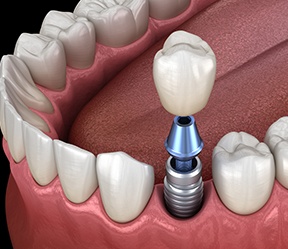 Animated smile during dental implant supported dental crown placement