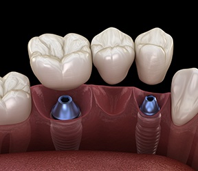 Animated smile during dental implant supported fixed bridge placement