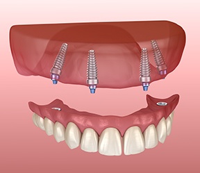 Animated smile during dental implant supported denture placement