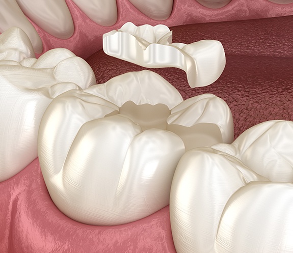 Animated smile during inlay placement