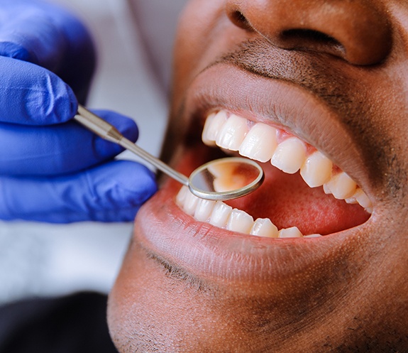Dentist examining man's smile after tooth colored filling restoration