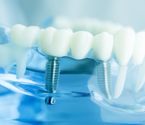 Model smile with dental implant supported fixed bridge