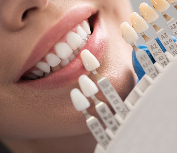 Smile compared with porcelain veneer shade chart