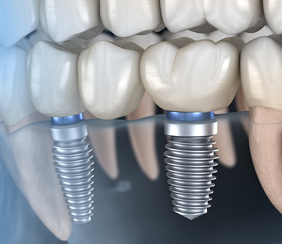 Animated smile with dental implant supported fixed bridge