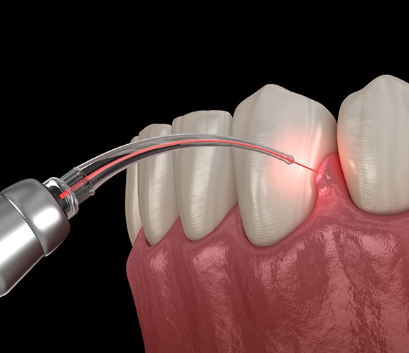 Animated smile during soft tissue laser dentistry