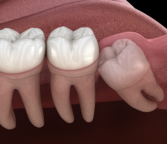 Animated smile with impacted wisdom tooth