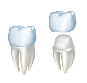 tooth restorations