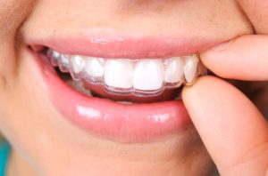 Invisalign aligners in Washington, DC are fully removable.