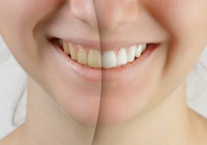 Wondering how you can get ready for Summer? Teeth whitening from your dentist in Friendship Heights is the quickest way to achieve the results you’re looking for. 