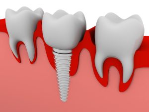 dental implant and crown