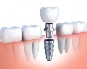 diagram of dental implant, abutment, and crown