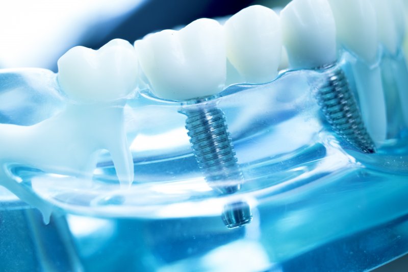 Dental implants in Washington DC